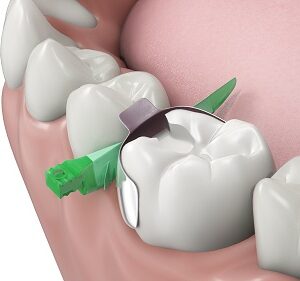 Composi-Tight® 3D Fusion™ Full Curve Matrix Bands