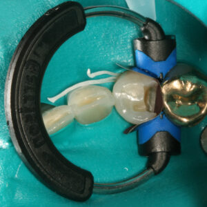 SlickBands™ XR-Series Sectional Matrix Bands